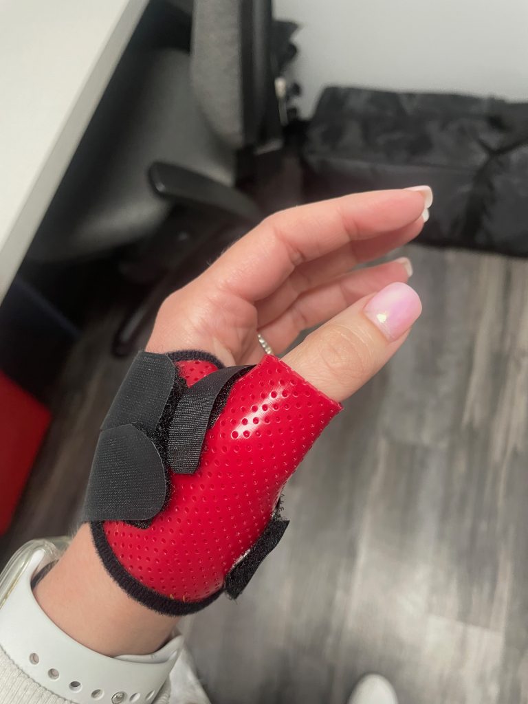 Casey Blaesing's hand in an occupational therapy glove.