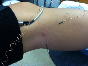 Patient receiving a nerve recording.